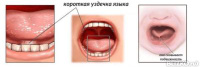 Как быть после пластики уздечки языка Как быть после пластики уздечки языка