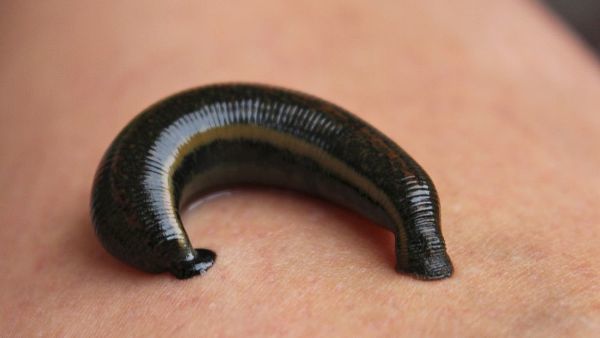 Лечение гирудотерапией в геникологии - Статьи - Курортная Клиника ...