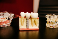 Снятие коронки литой (стоматология)